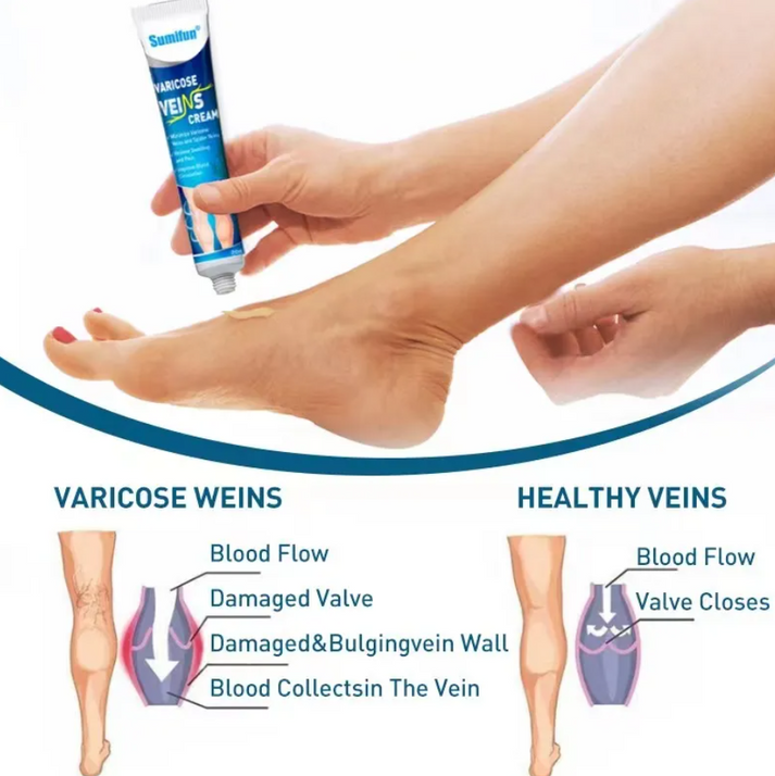 Varicose Veins Ointment